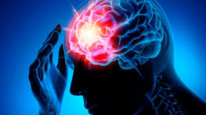 Інсульт, сучасні погляди на проблему