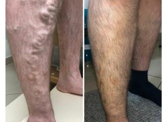 Малоінвазивні методи лікування варикозної хвороби  в КНП ШМР «Шумська міська лікарня»